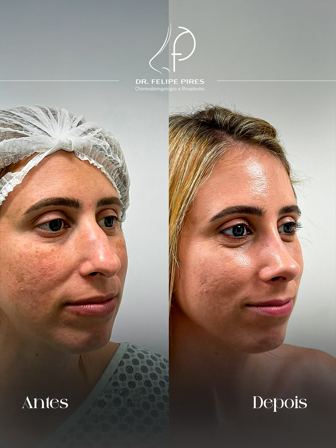 Resultado de rinoplastia 2 — Dr. Felipe Pires