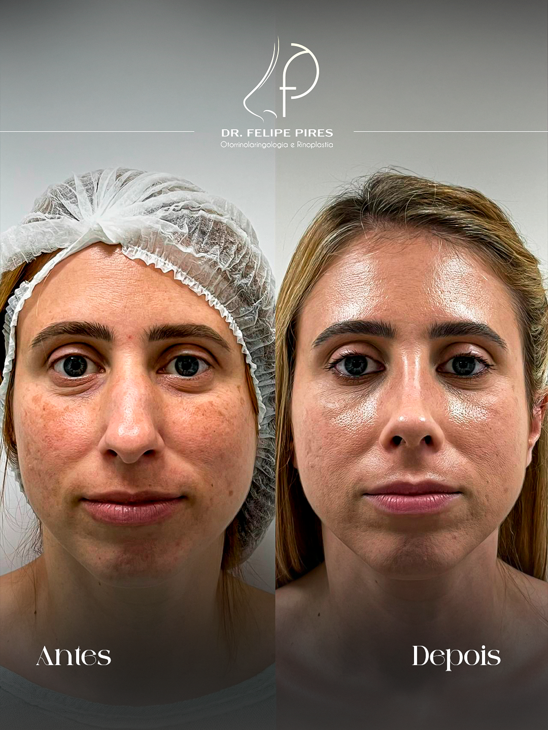 Resultado de rinoplastia 1 — Dr. Felipe Pires